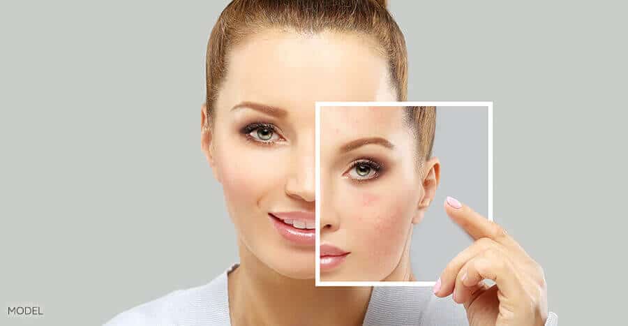 acne treatment, Acne