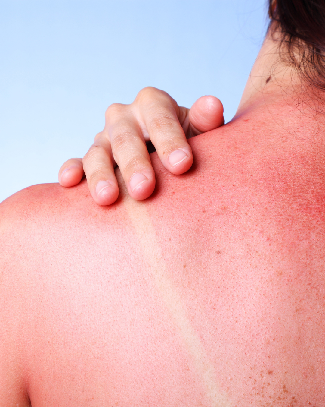 Sunburned shoulder and upper back with a hand resting on reddened skin under a blue sky