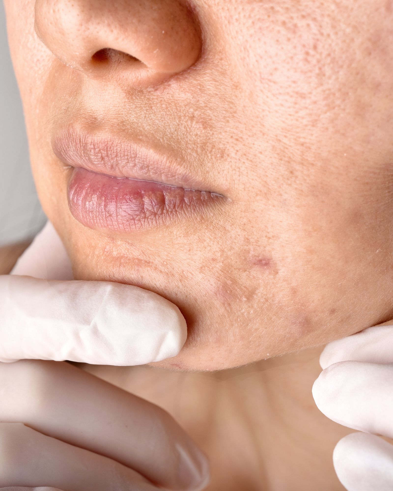 Close-up of the lower face showing textured skin with visible pores and a small red blemish near the chin, with a gloved hand nearby.